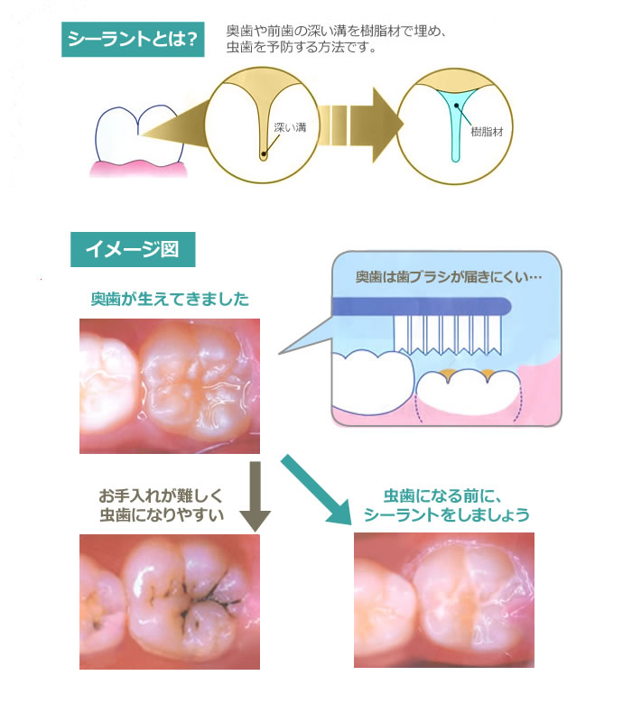 シーラント
